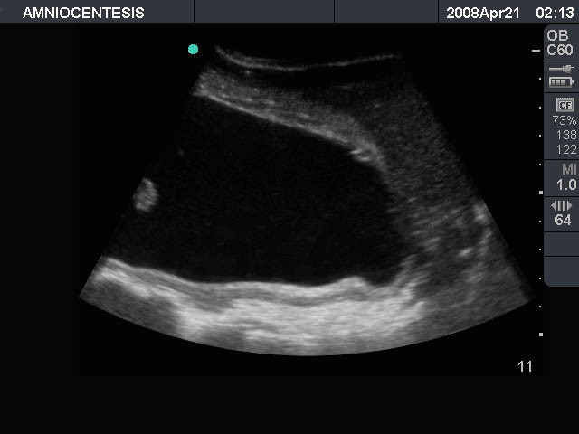 ultrasound_amniocentesis_cervix_needle